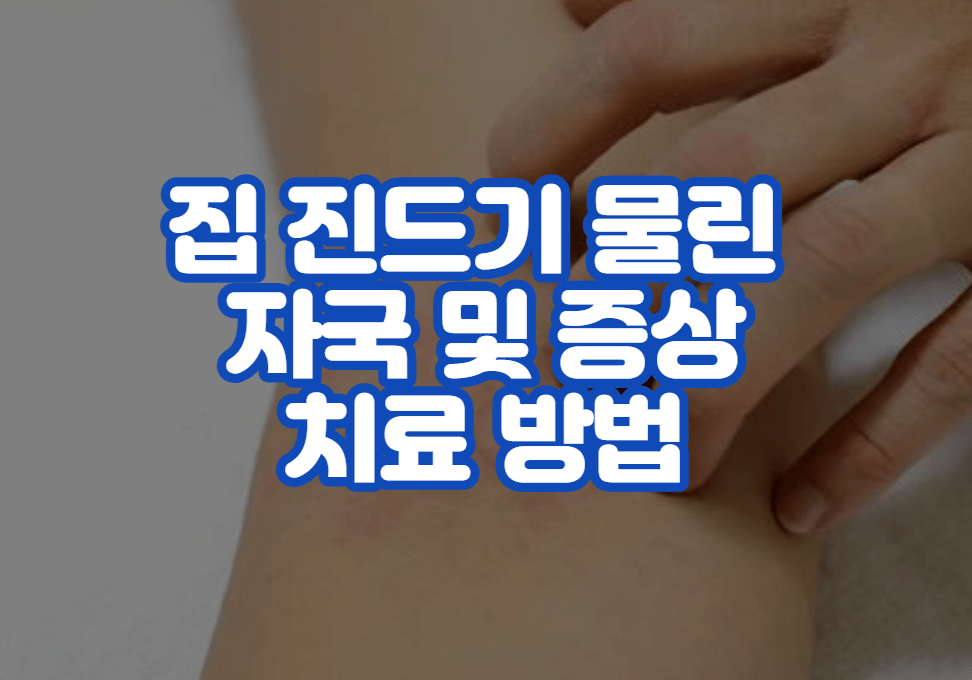 집 진드기 물린 자국 및 증상 치료 방법